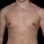 Gynecomastia Before & After Patient #868