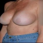 Breast Augmentation Before & After Patient #980