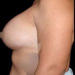 Breast Augmentation Before & After Patient #992