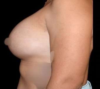 Breast Augmentation Before & After Patient #992