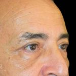 Blepharoplasty Before & After Patient #1000