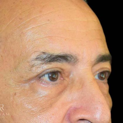 Blepharoplasty Before & After Patient #1000