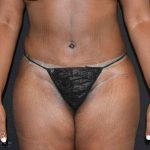Tummy Tuck Before & After Patient #737