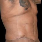Tummy Tuck Before & After Patient #749