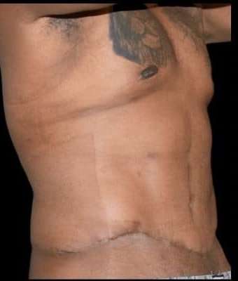 Tummy Tuck Before & After Patient #749