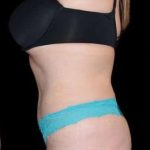 Tummy Tuck Before & After Patient #770