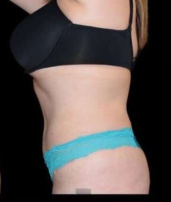 Tummy Tuck Before & After Patient #770
