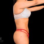 Brazilian Butt Lift Before & After Patient #805