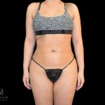 Liposuction Before & After Patient #819