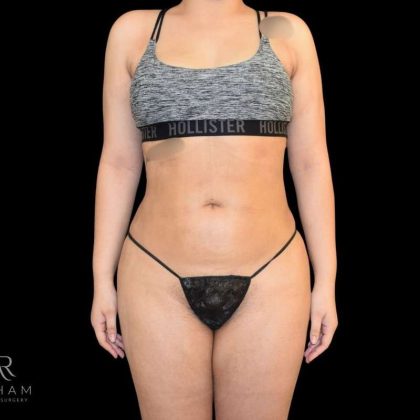 Liposuction Before & After Patient #819