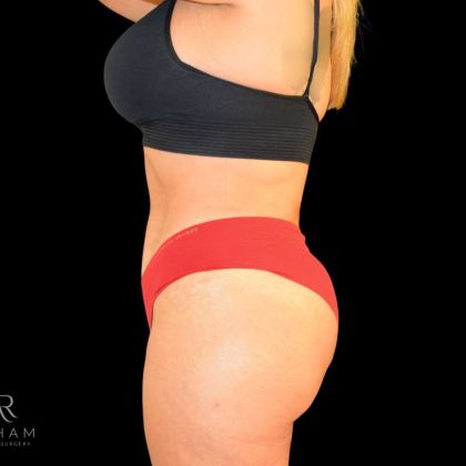 Liposuction Before & After Patient #826