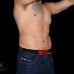 Liposuction Before & After Patient #833