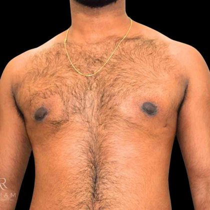 Gynecomastia Before & After Patient #854