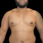 Gynecomastia Before & After Patient #861