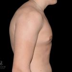 Gynecomastia Before & After Patient #868