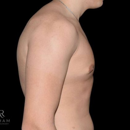 Gynecomastia Before & After Patient #868