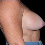 Breast Augmentation Before & After Patient #980