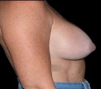 Breast Augmentation Before & After Patient #980