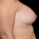Breast Augmentation Before & After Patient #992