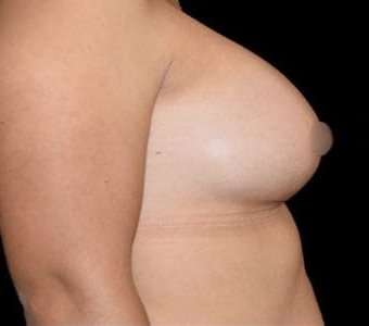 Breast Augmentation Before & After Patient #992