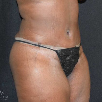 Tummy Tuck Before & After Patient #737