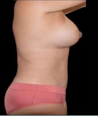 Tummy Tuck Before & After Patient #744