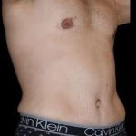 Tummy Tuck Before & After Patient #756