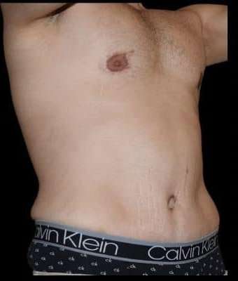 Tummy Tuck Before & After Patient #756
