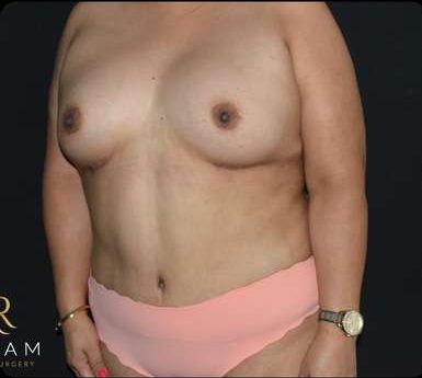 Mommy Makeover Before & After Patient #383