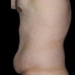 Tummy Tuck Before & After Patient #756