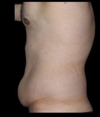 Tummy Tuck Before & After Patient #756