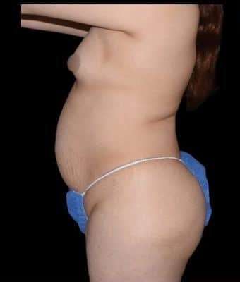 Tummy Tuck Before & After Patient #763