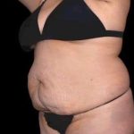 Tummy Tuck Before & After Patient #770