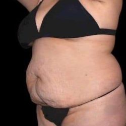 Tummy Tuck Before & After Patient #770