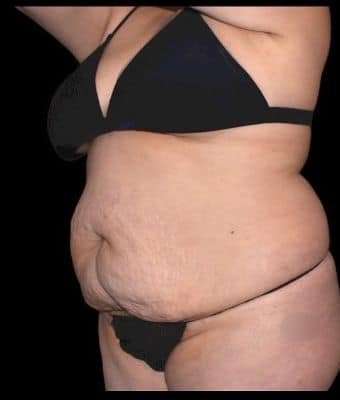 Tummy Tuck Before & After Patient #770