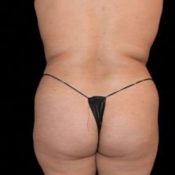 Brazilian Butt Lift Before & After Patient #784