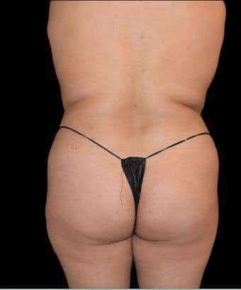 Brazilian Butt Lift Before & After Patient #784