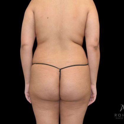 Brazilian Butt Lift Before & After Patient #791