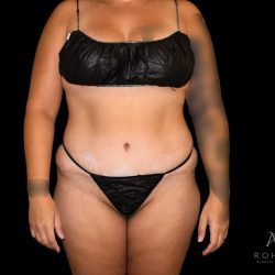 Liposuction Before & After Patient #826