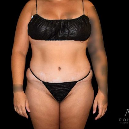 Liposuction Before & After Patient #826