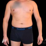Liposuction Before & After Patient #833