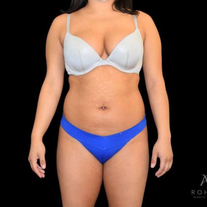 Liposuction Before & After Patient #840