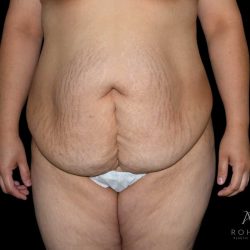 Liposuction Before & After Patient #847