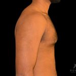 Gynecomastia Before & After Patient #854