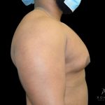 Gynecomastia Before & After Patient #861