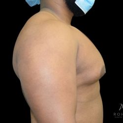 Gynecomastia Before & After Patient #861