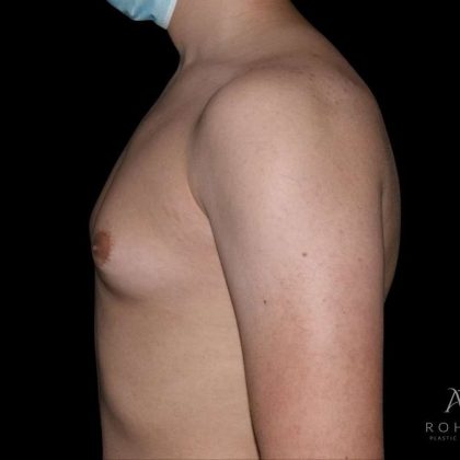 Gynecomastia Before & After Patient #868