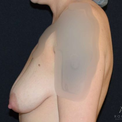 Breast Lift Before & After Patient #882