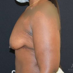 Breast Lift Before & After Patient #889
