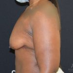 Breast Augmentation Before & After Patient #938